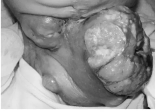 Fig. 2　Applying Mohs paste for the first time Softened up by the body temperature.