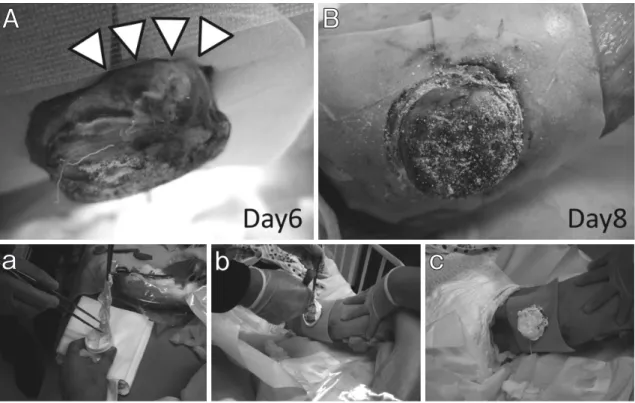 Fig. 1　Mohs’ gauze method A