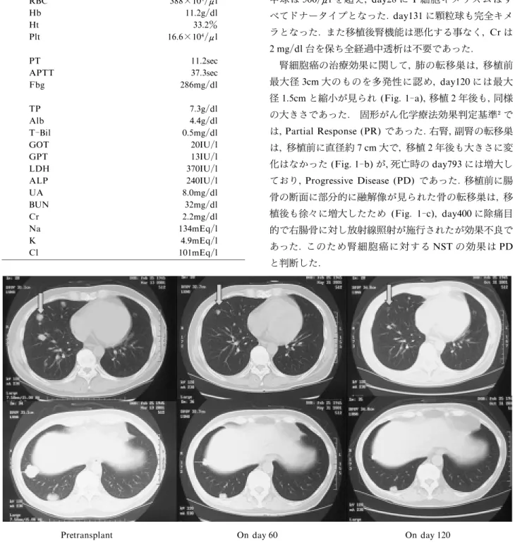 Fig. 1 ‑ a. CT images of pulmonary metastases pretransplant, on day 60 and on day120 after PBSCT