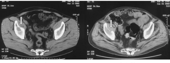 Fig. 1 ‑ c. CT images of bone metastases pretransplant, on day 300 after PBSCT. The CT images show bone metastases.