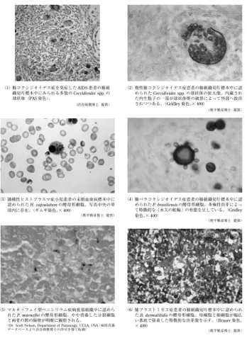 図 2 直接鏡検または病理組織検査による各輸入真菌症原因菌の検出例  （図 2 は巻末のカラーページに掲載しています。 ）肺コクシジオイデス症を発症した AIDS 患者の肺組織切片標本中にみられる多数の Coccidioides spp