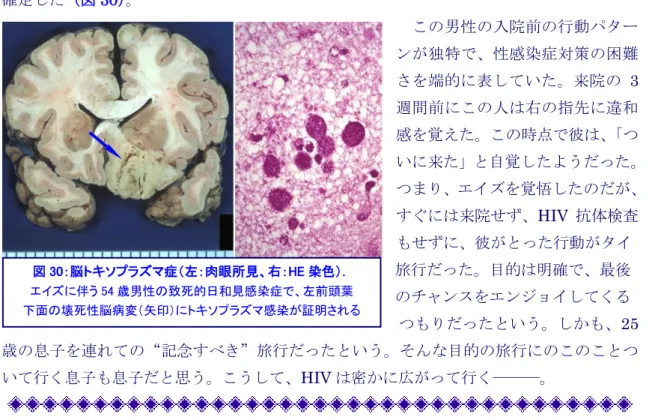 図 30：脳トキソプラズマ症（左：肉眼所見、右：HE 染色）．  エイズに伴う 54 歳男性の致死的日和見感染症で、左前頭葉  下面の壊死性脳病変（矢印）にトキソプラズマ感染が証明される 