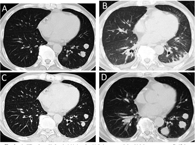 Fig. 1. A : CT performed before the initiation of sunitinib therapy revealed multiple lung metastases