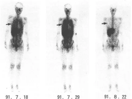Fig.  2  67Ga scintigram  showing  diffuse  uptake  by  both  lungs.  67Ga localization  in  the  lung  is  less  than  in  the  liver  4  days  after  administration  of  sulfamethoxazole-trimethoprim  (SMX-TMP)  (left),  but  it  is  equivalent  to  or  