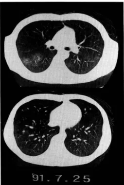 Fig.  3  Chest  CT  scan  after  11  days  of  administra- administra-tion  of  SMX-TMP,  showing  diffuse  interstitial  reticular  changes