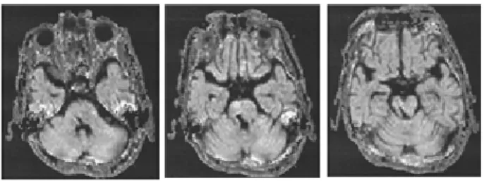 図 1 訪問リハビリテーション開始時頭部MRI画像（DWI：拡散強調画像）図1　訪問リハビリテーション開始時頭部MRI画像（DWI：