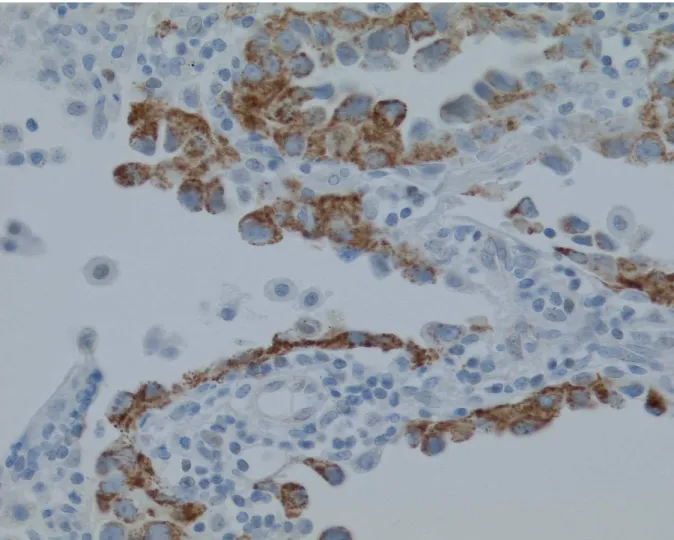図 4 4 4 4    微小浸潤 微小浸潤 微小浸潤を 微小浸潤 を を を示 示 示 示す す肺腺癌 す す 肺腺癌 肺腺癌 肺腺癌における における における における OCIAD2 OCIAD2 の OCIAD2 OCIAD2 の の の免疫染色 免疫染色 免疫染色 免疫染色  胞体内胞体内胞体内 胞体内におけるにおけるにおける における顆粒状顆粒状顆粒状 顆粒状のの の染色像の染色像 染色像を染色像 を陽性をを陽性陽性 陽性ととと と判定 判定した判定判定したした した。。 。 。        