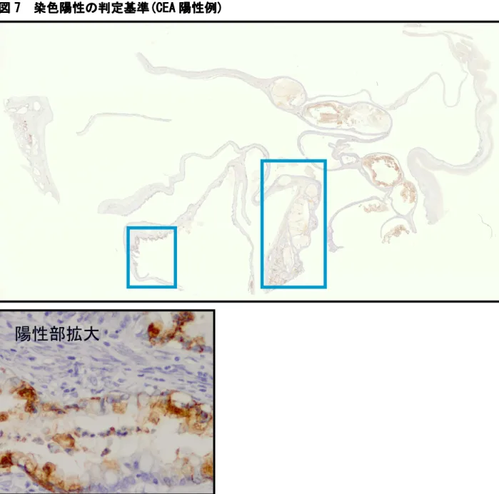 図 7 7 7 7        染色陽性    染色陽性 染色陽性の 染色陽性 の の の判定基準 判定基準( 判定基準 判定基準 ( ( (CEA CEA CEA CEA 陽性例 陽性例 陽性例 陽性例) ) ) ) 