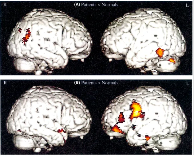 図 １ ８ － ７   意 味 判 断 課 題 遂 行 時 に お け る 意 味 認 知 症 （Patients）と  健 常 者 （ Normals）の酸素消費量変化の比較  ２ ） 機 能 画 像 解 析 所 見 ～ SD では形態画像解析と同じく機能画像解析でも側頭葉領野の 機 能 低 下 が 認 め ら れ る が 、そ の 範 囲 は よ り 広 範 に 及 ぶ 。 1992 年のホッジスらのグループの 報 告 例 ４ 例 は い ず れ も SPECT もしくは PET で機能低下を認めたが、