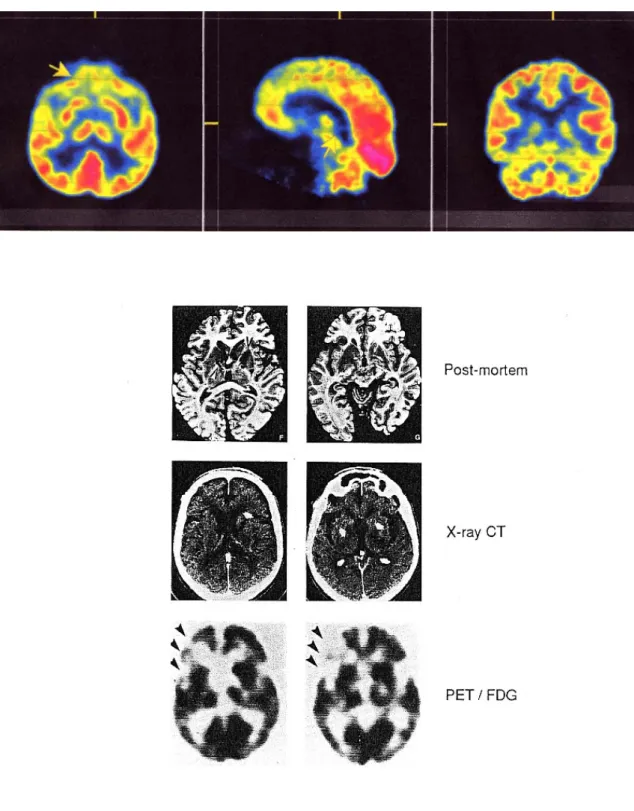 図 ２ － ８   PET による脳グルコース代謝画像（上段）および同一領野の剖検