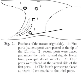 Fig. 1. Positions of the trocars (right side). 1 : First ports (camera port) were placed at the tip of the 12th rib