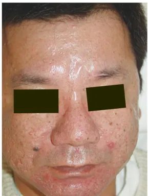 Fig. 1　this patient is a 43 years old seborrheic dermatitis  patient.