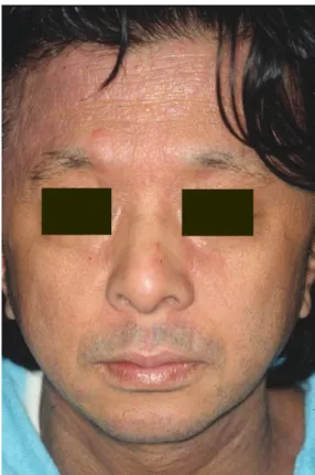 Fig.  5　This  figure  is  the  skin  after  the  treatment.  Redness and lichenification are markedly improbed.