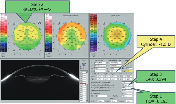 図 2 角膜倒乱視眼の Cataract Pre-OP display 例 2