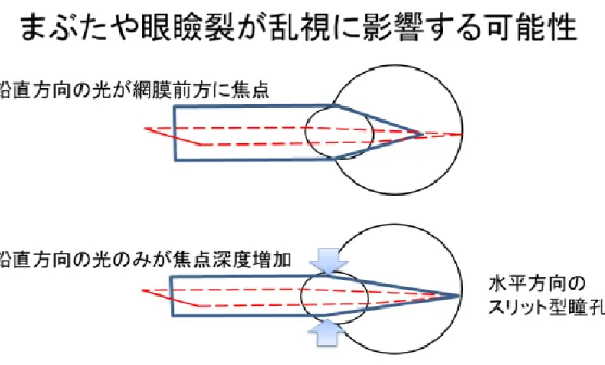 図 11  まぶたや眼瞼裂が乱視に影響する可能性． 