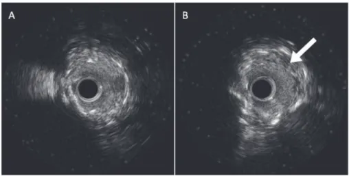 図 2　IVUS 像（症例 1）．
