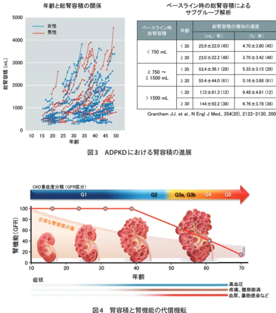 図 3   ADPKD における腎容積の進展 図 4  腎容積と腎機能の代償機転 腎機能は残存ネフロンによりある時期まで代償されるが，以後腎機能低下が生じ， CKD stage が進行する，これに伴い合併症も加わる． 表 1   CKD の重症度分類 原疾患 蛋白原区分 A1 A2 A3 糖尿病 尿アルブミン定量（ 尿アルブミン /Cr 比（ mg/ mg/gCr日） ） 正常 微量アルブミン尿 顕性アルブミン尿 30 未満 30 ∼ 299 300 以上 高血圧 腎炎 多発性嚢胞腎 移植腎 不明 その他 