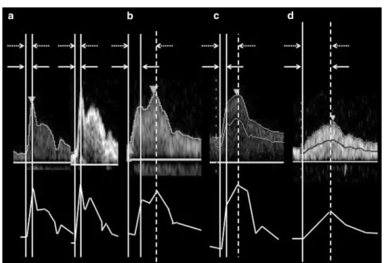 Fig. 1    Measurements of  conventional AcT and PSV  AcT. “Conventional AcT” 