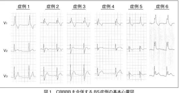 図 1　CRBBBを合併する BS症例の基本心電図