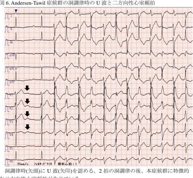 図 6. Andersen-Tawil 症候群の洞調律時の U 波と二方向性心室頻拍  洞調律時(矢頭)に U 波(矢印)を認める。2 拍の洞調律の後、本症候群に特徴的 な二方向性心室頻拍が生じている。  5-2