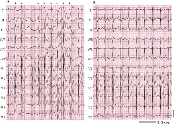 図 10.  フレカイニド投与前後のトレッドミル運動負荷検査(症例#4)  A.  フレカイニド投与前の運動負荷試験中の心電図所見、最大 6 連発までの心室 性不整脈(*)を認める。B
