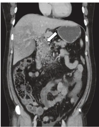 図 1 ： Abdominal enhanced Computed Tomography (CT) findings on the day of onset 　　　　Thrombus was noted from the portal vein to the superior mesenteric vein (arrow).