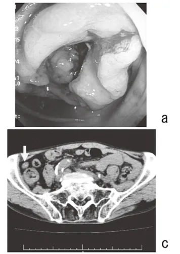 Fig. 1  (a)大腸内視鏡検査 ： ほぼ全周性の 2 型の腫瘍を認める． (b) CT virtual colonoscopy ： 上行結腸にapple core sign様所 見を認める． (c) 単純CT ： 虫垂内に点状の高吸収域を認める．