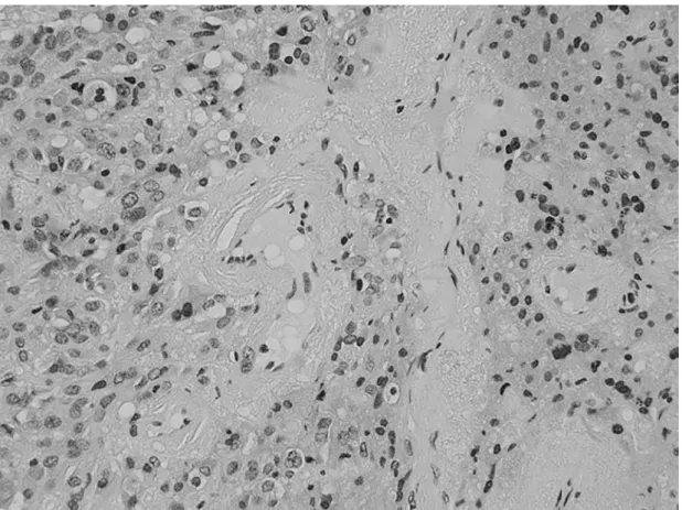 Figure 4B: Amyloid was present in the background, confirmed by Congo red (direct fast scarlet) staining.