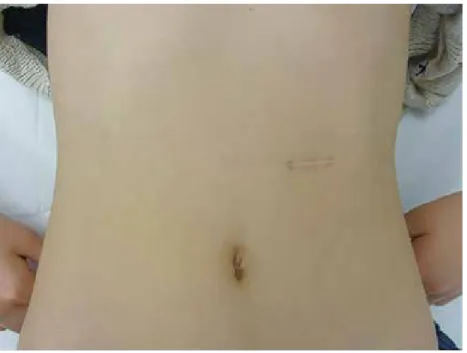 Fig. 4.  Current abdominal appearance: Two years old surgical scar do not draw much attention.