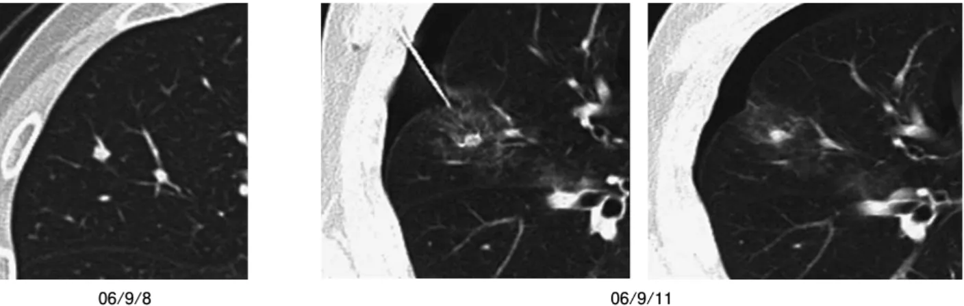 Fig. 1 (a).70 歳，男性．大腸癌術後の患者で VATS 後に右上葉に新しい肺転移を認めた（06’ /9/8）．２cm 用の Cool tip 針にて穿刺 し周囲にすりガラス陰影と若干の気胸を認める（06’ /9/１１）． Table 1.患者背景針                                                                                                                        ᕈ೎㧧↵ᕈ1