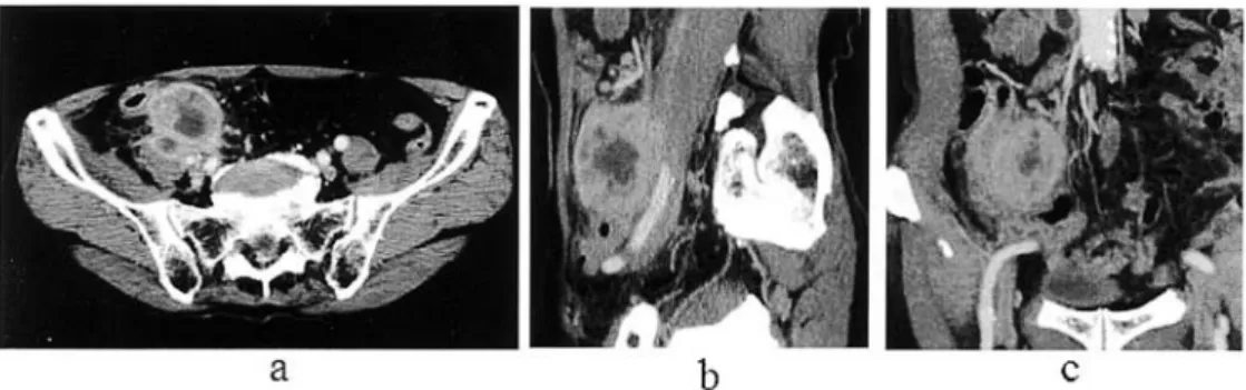 Fig. 3. Images from abdominal computer tomography.  Abdominal computed tomography from November  of 2005 showed that the tumor invaded the right psoas muscle