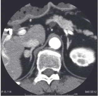 Fig. 1. Dynamic CT scanning. A : Unenhanced CT image  shows a low density (9HU) mass (arrow), 15mm×11mm in  size, in the right adrenal gland