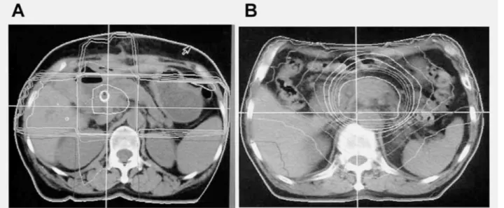 Fig. 2. External‑beam radiotherapy was delivered using a four‑field technique (A) or a conformal technique (B)