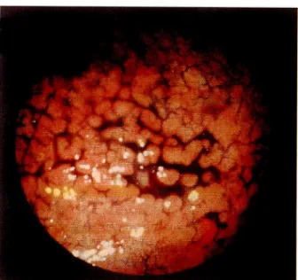 Figure 4. By dye spraying method, various-sized granules with sporadically distributed sulcus-like erosions can be recognized easily.
