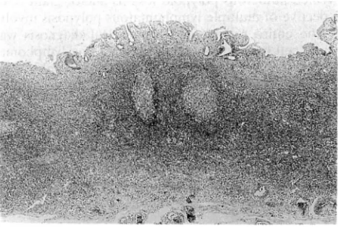 Fig. 1. Case 1. HEX 10. Lymphoma cells infiltrate diffusely in mucosa propria and submucosal layer