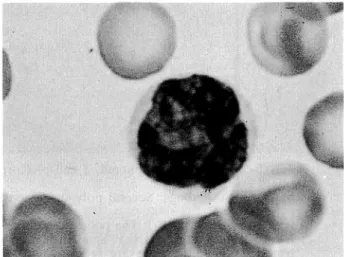 Fig. 1. Atypical lymphocyte in the peripheral blood.