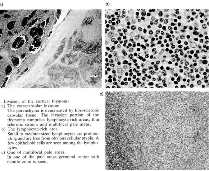 Fig. 2. Invasion of the cortical thymoma a) The extracapsular invasion
