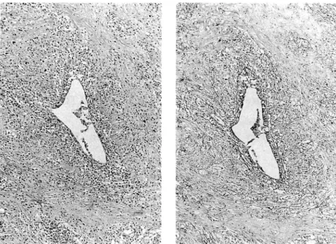 Fig. 2. lymphoepitheHal lesion (LEL). (a) HE. (b) Silver impregnation.