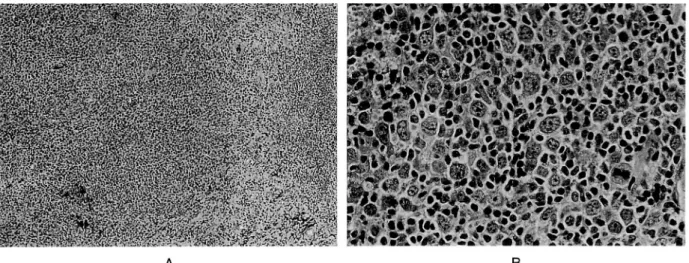 Fig. 2. Intra-oral tumor. A (left): The tumor is composed of diffuse proliferation of lymphoid cells