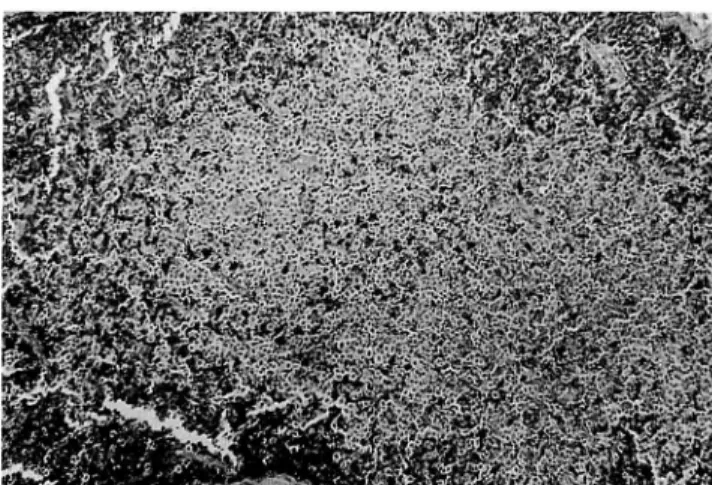 Fig. 7. Immunostain of skin nodule: The proliferative plasma cells are positive with anti-lambda anti body.