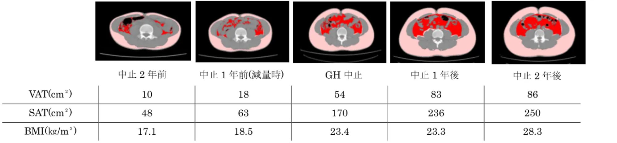 図 5  GH 中止前後における fat scan による脂肪分布の推移(症例②)