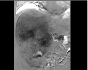 Figure  6  shows  the  excised  right  lung.  Dark-red  nodular lesions measuring about 12×11 mm and about  8×5 mm were present in the right lung lower lobe