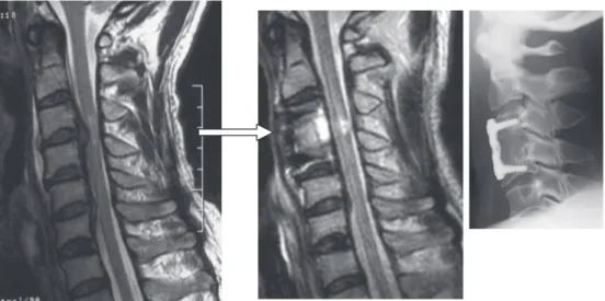 Fig. 5 Neurological improved case（ASIA A→D） 37 year old male. Operation was performed 3.5 hours from the onset.