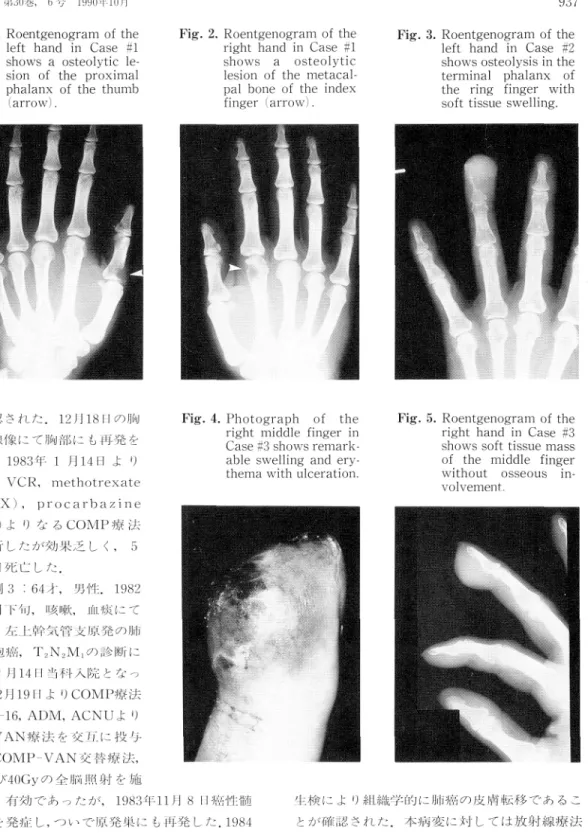 Fig.  1.  Roentgenogram  of  the left  hand  in  Case  #1 shows  a  osteolytic   le-sion  of  the  proximal phalanx  of  the  thumb