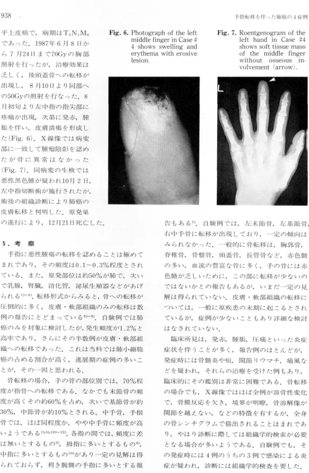 Fig.  6.  Photograph  of  the  left middle  finger  in  Case  # 4  shows  swelling  and erythema  with  erosive lesion.