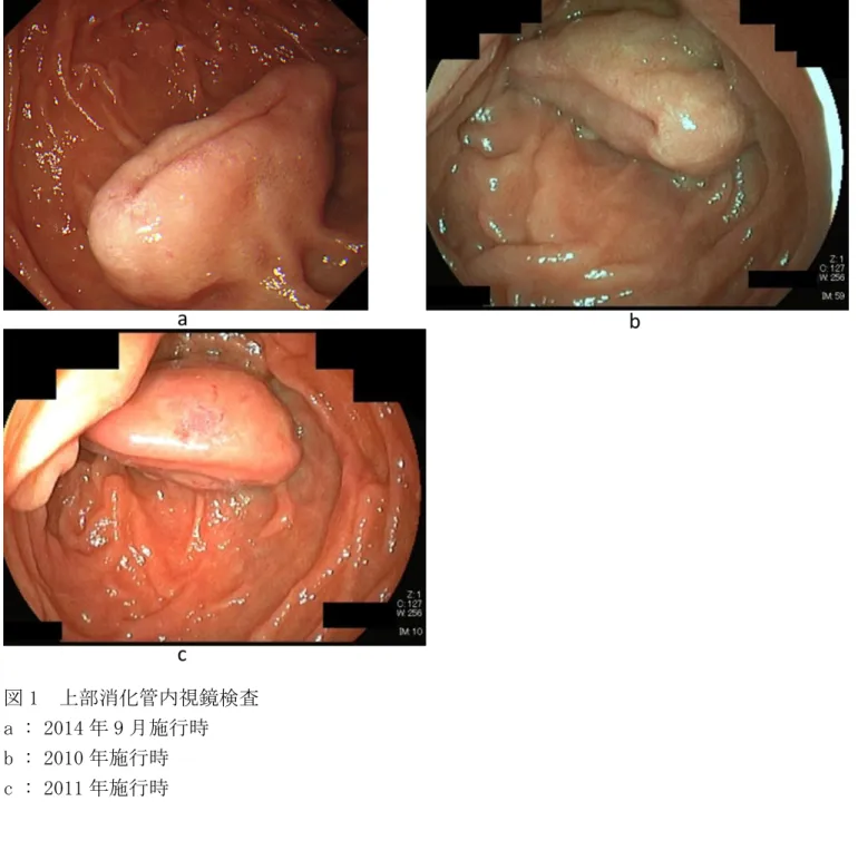 図 1  上部消化管内視鏡検査  a : 2014 年 9 月施行時  b : 2010 年施行時  c : 2011 年施行時 