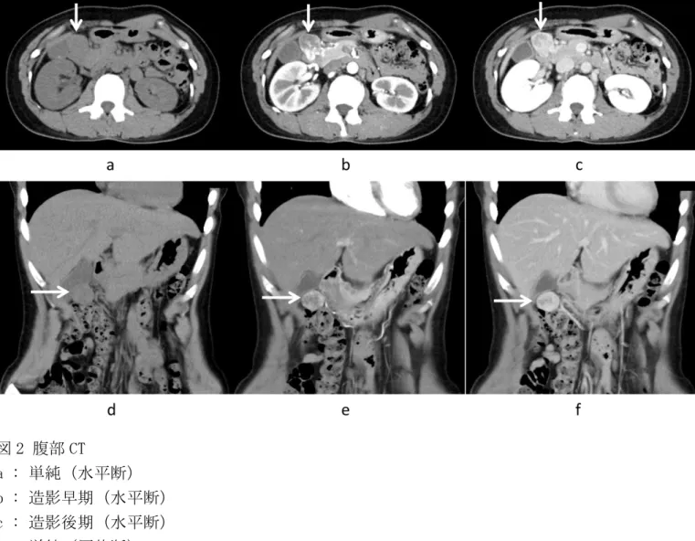 図 2 腹部 CT  a : 単純（水平断）  b : 造影早期（水平断）  c : 造影後期（水平断）  d : 単純（冠状断）  e : 造影早期（冠状断）  f : 造影後期（冠状断）    早期相から後期相にかけて徐々に濃染される腫瘤を認めた（矢印）。 