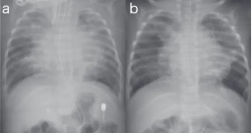 Fig. 2　Chest X-ray of Case 2.