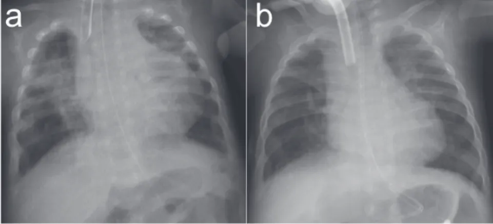 Fig. 3　Chest X-ray of Case 3.
