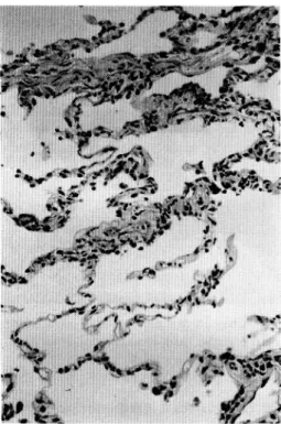 Fig.  5  Focal  alveolitis.  (HE  stain, •~50)